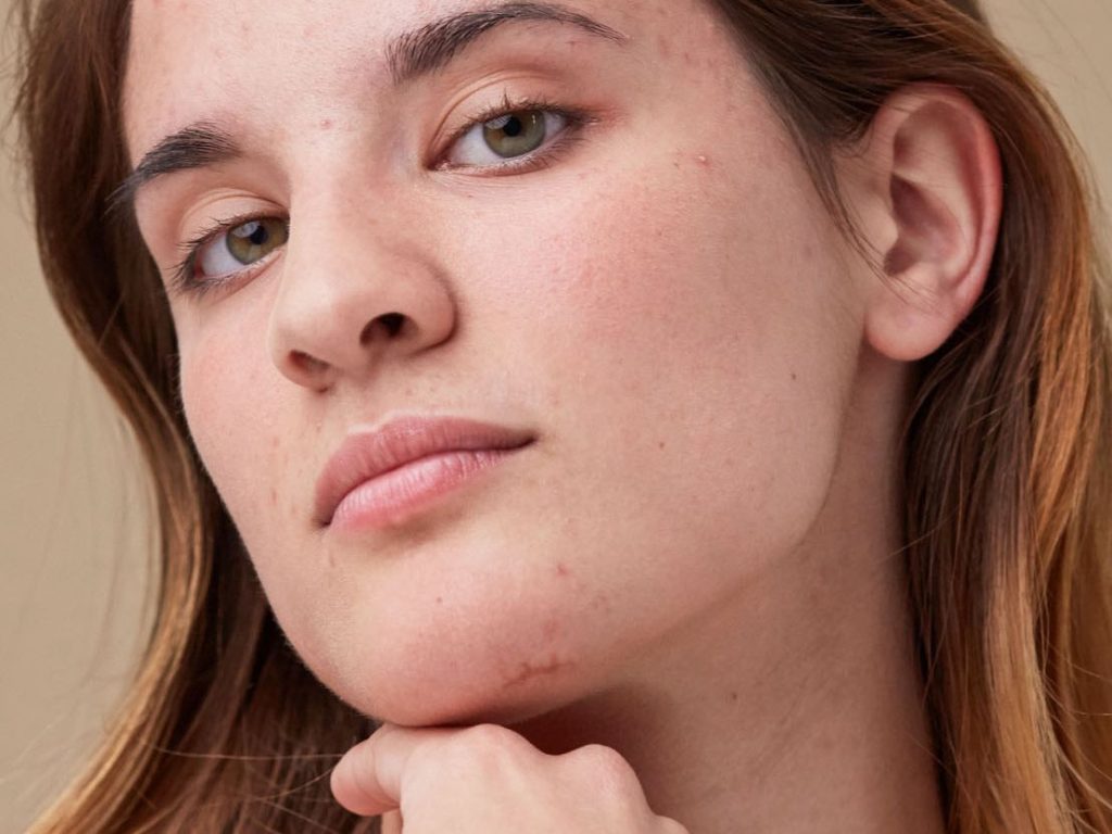 How to Get Rid of Acne Scars Overnight Naturally